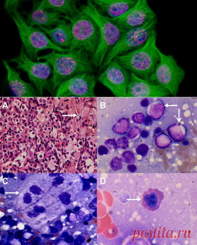 Временное «старение» раковых клеток, вызванное химиотерапией, может приводить к рецидиву
Даже успешная поначалу борьба с раковой опухолью может закончиться поражением: болезнь может вернуться. Один из базовых естественных механизмов предотвращения онкологических болезней – «запрет на размножение» для стареющих, изношенных клеток, которые могут стать родоначальниками опухоли. Однако и раковые...
Читай дальше на сайте. Жми подробнее ➡