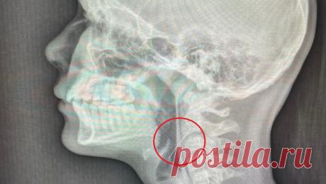 Школьница проглотила иголку, когда вешала на елку гирлянду. В Воронеже девочка украшала дом к Новому году и попала в больницу, ребенок случайно проглотил иглу. Об этом сообщает Минздрав Воронежской области на официальной странице во &quot;ВКонтакте&quot;. Девочка-подросток наряжала дома елку, ...