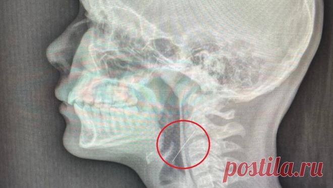 Школьница проглотила иголку, когда вешала на елку гирлянду. В Воронеже девочка украшала дом к Новому году и попала в больницу, ребенок случайно проглотил иглу. Об этом сообщает Минздрав Воронежской области на официальной странице во "ВКонтакте". Девочка-подросток наряжала дома елку, ...