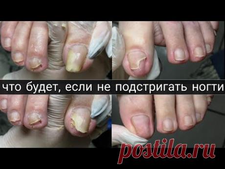 Онихолизис на ногтях. Полгода не стригла ногти на ногах. Лечение, удаление, зачистка