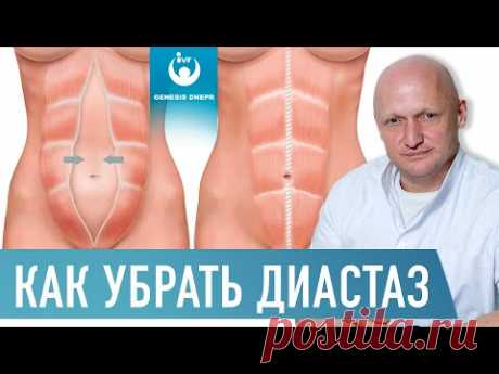ДИАСТАЗ (расхождение) прямых мышц живота. Причины, осложнения, лечение |Хирург Шевцов А.Н.