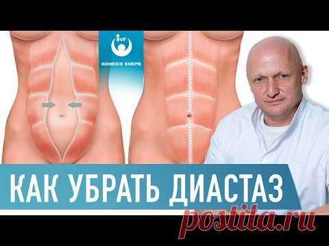 ДИАСТАЗ (расхождение) прямых мышц живота. Причины, осложнения, лечение |Хирург Шевцов А.Н.