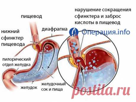 Грыжа пищевода скользящая и аритмия - Все о суставах Суставы восстановятся за 3 дня с помощью средства за 147 рублей! Читать подробнее! Мало кто знает, но именно это лечит суставы за 7 дней! Узнать! …