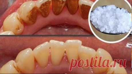 Зубной камень: вот, как вы можете удалить его самостоятельно, не посещая стоматолога — Полезные советы