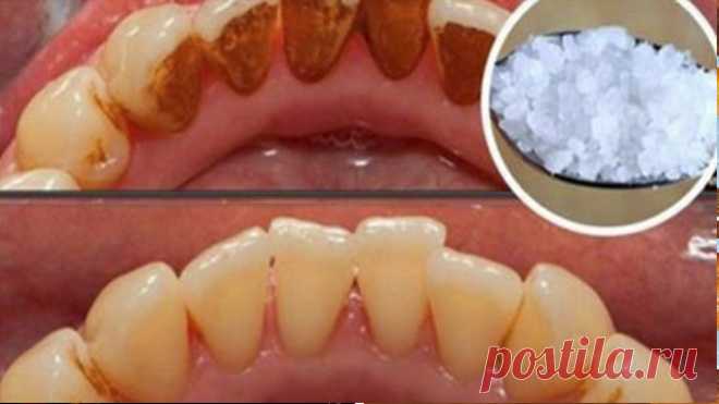 Зубной камень: вот, как вы можете удалить его самостоятельно, не посещая стоматолога — Полезные советы