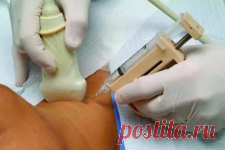 Все тонкости биопсии щитовидной железы
Здравствуйте, дорогие читатели! При наличии узлов щитовидной железы единственный метод определить их характер(злокачественный или доброкачественный)-это тонкоигольная аспирационная биопсия(ТАБ). Процедура эта при грамотном проведении безболезненна и эффективна. Как проводится ТАБ Под контролем УЗИ врач проводит пункцию(укол) в узел щитовидной железы тонкой...
Читай дальше на сайте. Жми подробнее ➡