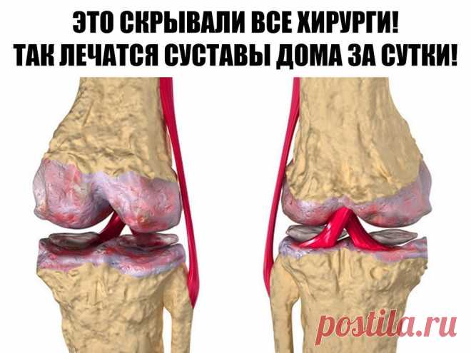 Это скрывали все хирурги! Так лечатся суставы дома за сутки Эта микстура «скорая помощь» от боли в суставах. Такая микстура должна быть в каждом доме. Ингредиенты: 1 сл. ложка крупной соли, 1 литр воды, нашатырный спирт, камфорное масло. Всыпьте 1 ст. ложку соли крупного помола в 1 л воды и размешайте. Отдельно возьмите 80-100 мл 10 %-го нашатырного спирта и