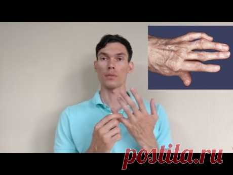 АРТРОЗ ПАЛЬЦЕВ РУК РАЗРАБОТКА arthrosis of the fingers