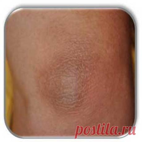 Если локти шелушатся | Народные рецепты здоровья