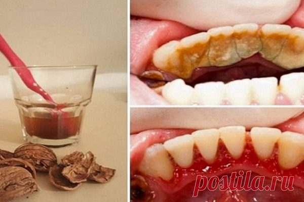 КАК ИЗБАВИТЬСЯ ОТ ЗУБНОГО КАМНЯ ПРИ ПОМОЩИ ОДНОГО ПРОСТОГО СРЕДСТВА – БУДЬ В ТЕМЕ