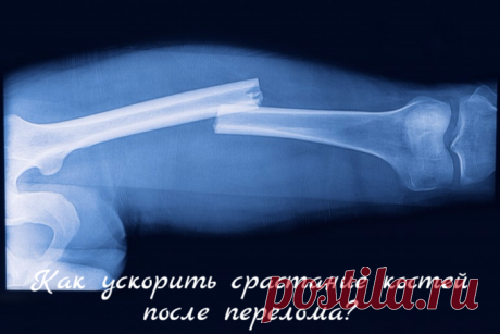 Как ускорить срастание костей после перелома?