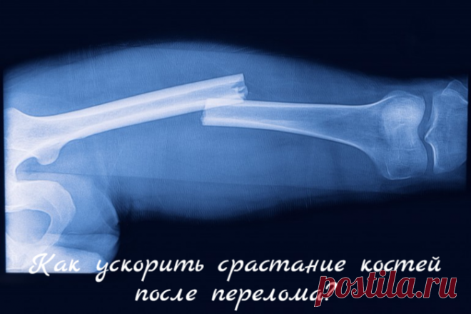 Как ускорить срастание костей после перелома?