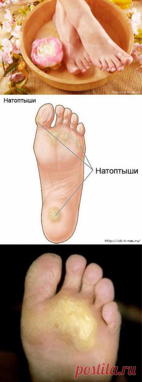КРАСИВОЙ БЫТЬ НЕ ЗАПРЕТИШЬ. ВСЕ ОБ ЭТОМ ЗДЕСЬ: https://idi-k-nam.ru/rubric/2796793/

Как избавиться от натоптышей в домашних условиях.