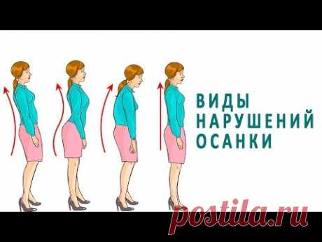 Виды нарушений осанки и их лечение