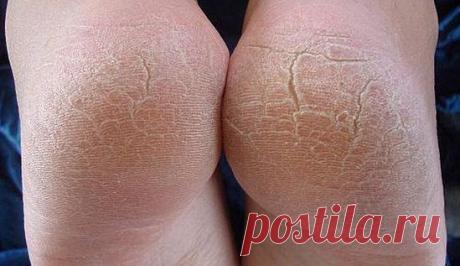 Трещины на пятках - причины, лечение народными средствами
Трещины на пятках - причины, провоцирующие факторы и хронические заболевания, лечение трещин пяток медикаментозно и народными средствами в домашних условиях