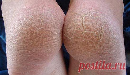 Трещины на пятках - причины, лечение народными средствами
Трещины на пятках - причины, провоцирующие факторы и хронические заболевания, лечение трещин пяток медикаментозно и народными средствами в домашних условиях