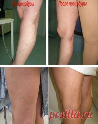 ფეხით და იჯდეს ოპერაციის შემდეგ ვენებში. ვარიკოზული ვენების ოპერაციის შემდეგ, აუცილებელი პოსტოპერაციული პერიოდი.