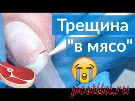 Трещина на ногте, ремонт без снятия ногтя - YouTube