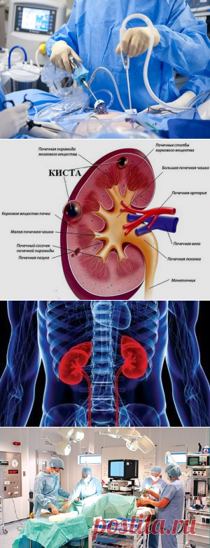 Киста почки - причины, симптомы, диагностика и лечение
