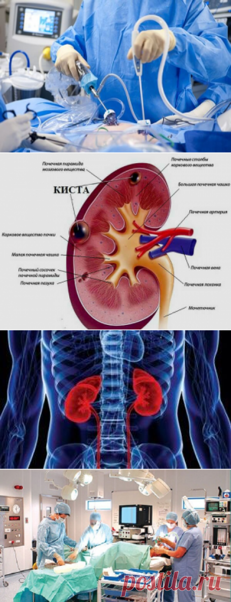 Киста почки - причины, симптомы, диагностика и лечение