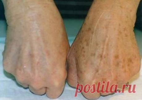 6 потрясающих народных методов против пигментных пятен » В сети – себя просвети! - Развлекательный портал!