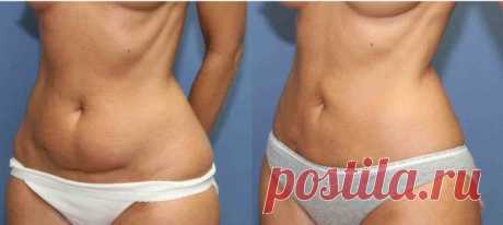 Я убрала дряблую кожу и висячий жир на животе при помощи аптечного препарата за 130 рублей | Решила похудеть | Яндекс Дзен