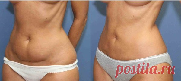 Я убрала дряблую кожу и висячий жир на животе при помощи аптечного препарата за 130 рублей | Решила похудеть | Яндекс Дзен