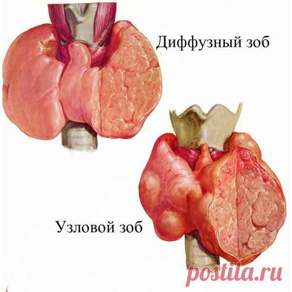 Диффузный зоб - симптомы, причины, степени и лечение диффузного зоба