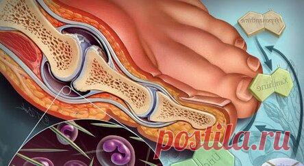 Страшная ПОДАГРА: Главный вредный продукт, который «подпитывает» эту болезнь