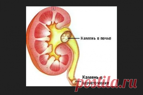 «Камни в почках 2 мм - Лечим печень. Лечим печень Лечение, симптомы, препараты камни в почках 2 мм Мочекаменная болезнь остаётся одной из самых распространенных урологических патологий среди лиц среднего и пожилого Мочекаменная болезнь остаётся одной из самых распространенных урологических патологий среди лиц среднего и пожилого возраста. Благодаря современным подходам к лечению, ее можно легко устранить с помощью малоинвазивных и безопасных методи...