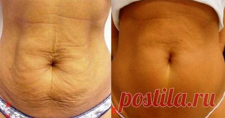 Мой опыт применения домашнего обертывания: жир на животе и целлюлит на бедрах пропали за 20 дней

Поправиться дело нехитрое, а вернуться к старым размерам тяжело. Перепробовав разные диеты, пришло полное разочарование. И тогда я решилась на крайние меры, а именно обертывания пищевой пленкой. Меры крайними показались лишь сначала. В действительности процедура оказалась простой и довольно приятной.