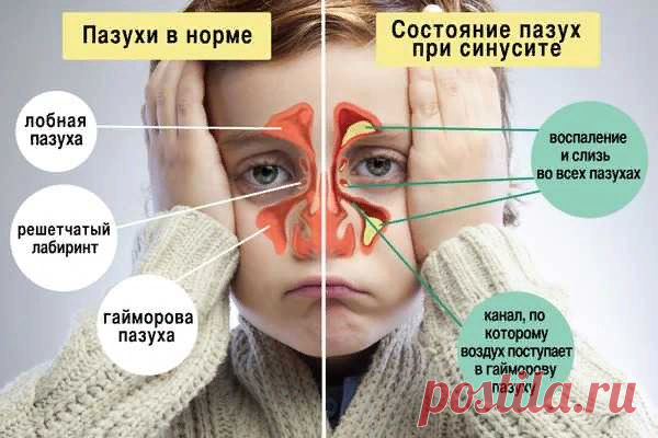 Воспаление носовых пазух: симптомы и лечение - Цитовир-3
