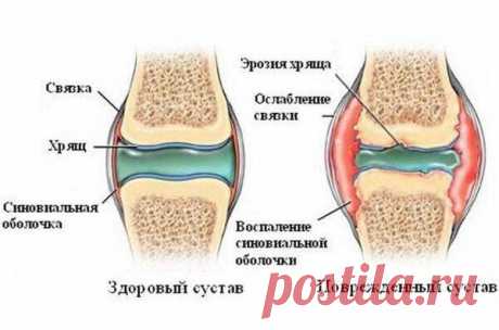 Причины суставной боли.