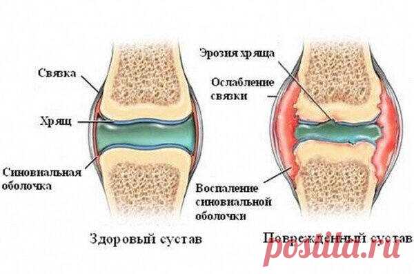 Причины суставной боли.