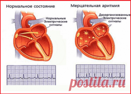 Мерцательная аритмия: дыхательная гимнастика и народные средства | Кладовая здоровья | Яндекс Дзен