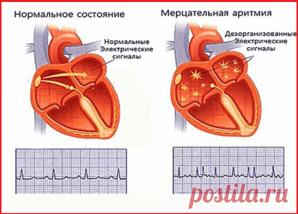 Мерцательная аритмия: дыхательная гимнастика и народные средства | Кладовая здоровья | Яндекс Дзен