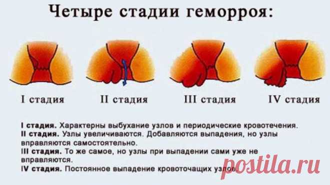 Лечение геморроя — рецепты мы не скроем. Очень средства ценные, в лечении отменные