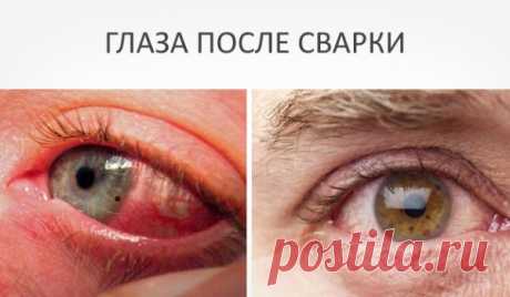 Болят глаза от сварки: что делать в домашних условиях, чем снять боль