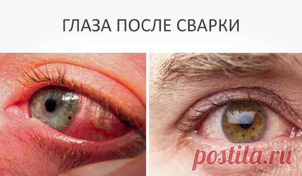 Болят глаза от сварки: что делать в домашних условиях, чем снять боль