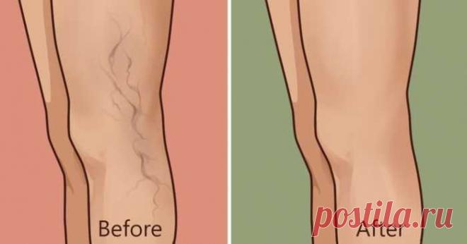 5 домашних средств, которые вы можете использовать для устранения варикозных вен в ногах! — Домашние