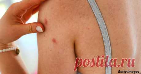 13 странных пятен на коже, которые вы обязательно должны проверить Очень важная информация!