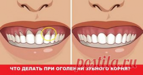 Оголилась шейка зуба? Узнай, как вернуть десну обратно! Домашнее лечение.