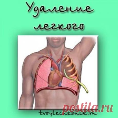 Удаление легкого | tvoylechebnik.ru