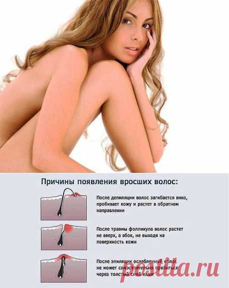Как избавиться от вросших волос