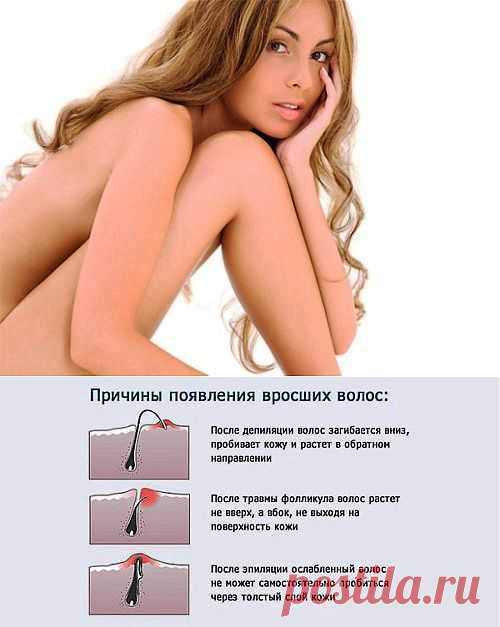 Как избавиться от вросших волос