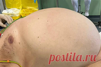 Опухоль весом с семилетнего ребенка выросла в животе у россиянина. В больнице Санкт-Петербурга у 59-летнего мужчины в животе нашли опухоль весом 26 килограмм — это сопоставимо с весом семилетнего ребенка. Новообразование занимало практически все пространство от диафрагмы до таза россиянина. Операция по удалению липосаркомы длилась три часа.