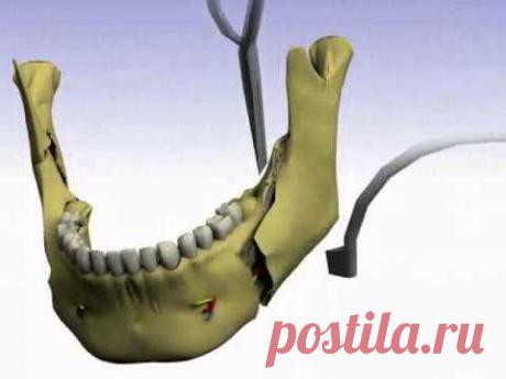 Вывих челюсти: симптомы и лечение : Лечение : Здоровье : Subscribe.Ru