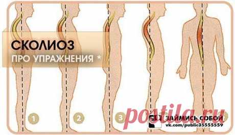 Упражнения при сколиозе:: smartinf