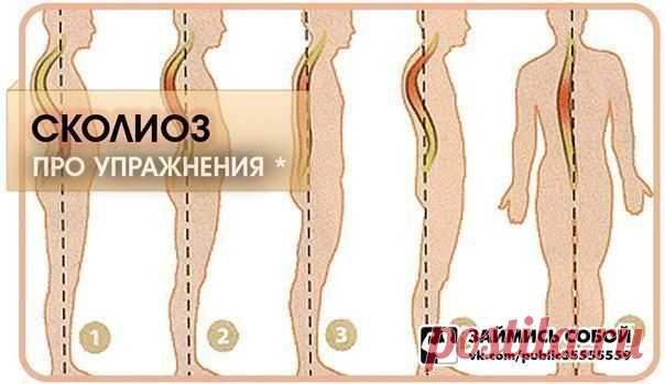Упражнения при сколиозе:: smartinf