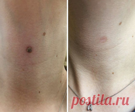 Ацикловир мазь от папиллом : инструкция, цена, отзывы